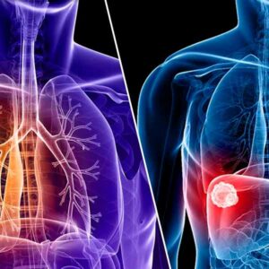 Suman 31 los casos de cáncer de pulmón y páncreas detectados durante este año