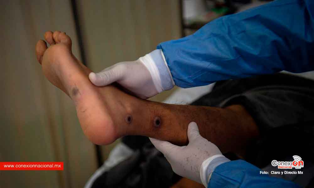 Ya van 3 mil casos y 4 muertos por viruela del mono, que ya está presente en todo México