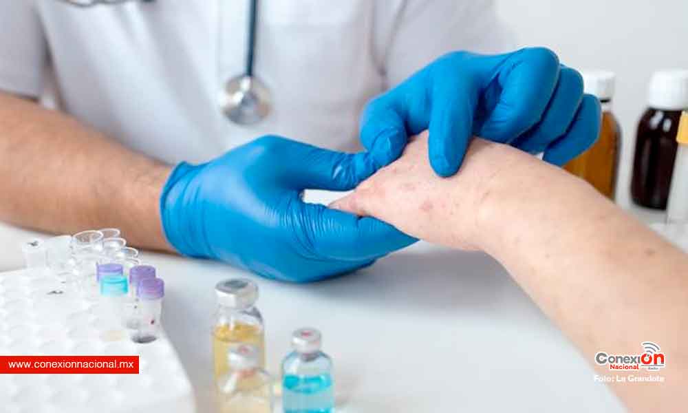 Chihuahua acumula 17 casos de viruela del mono